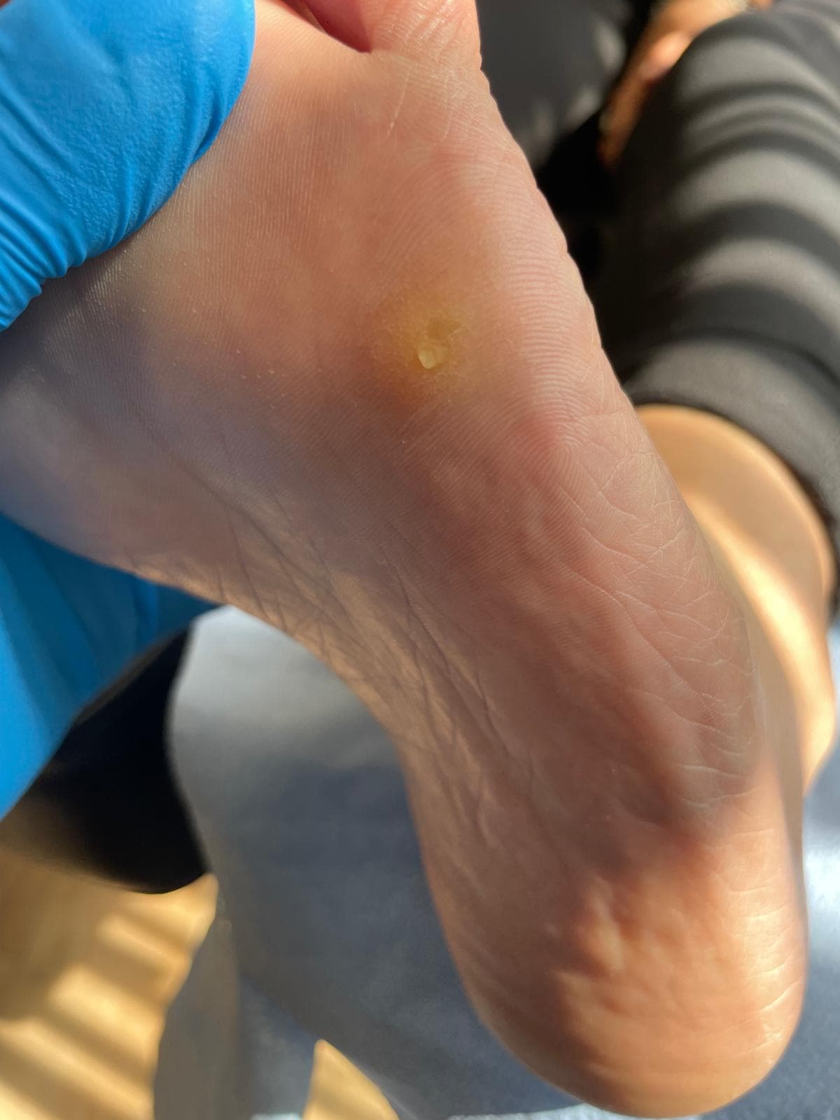 Corn Treatment (Heloma Durum) before treatment
