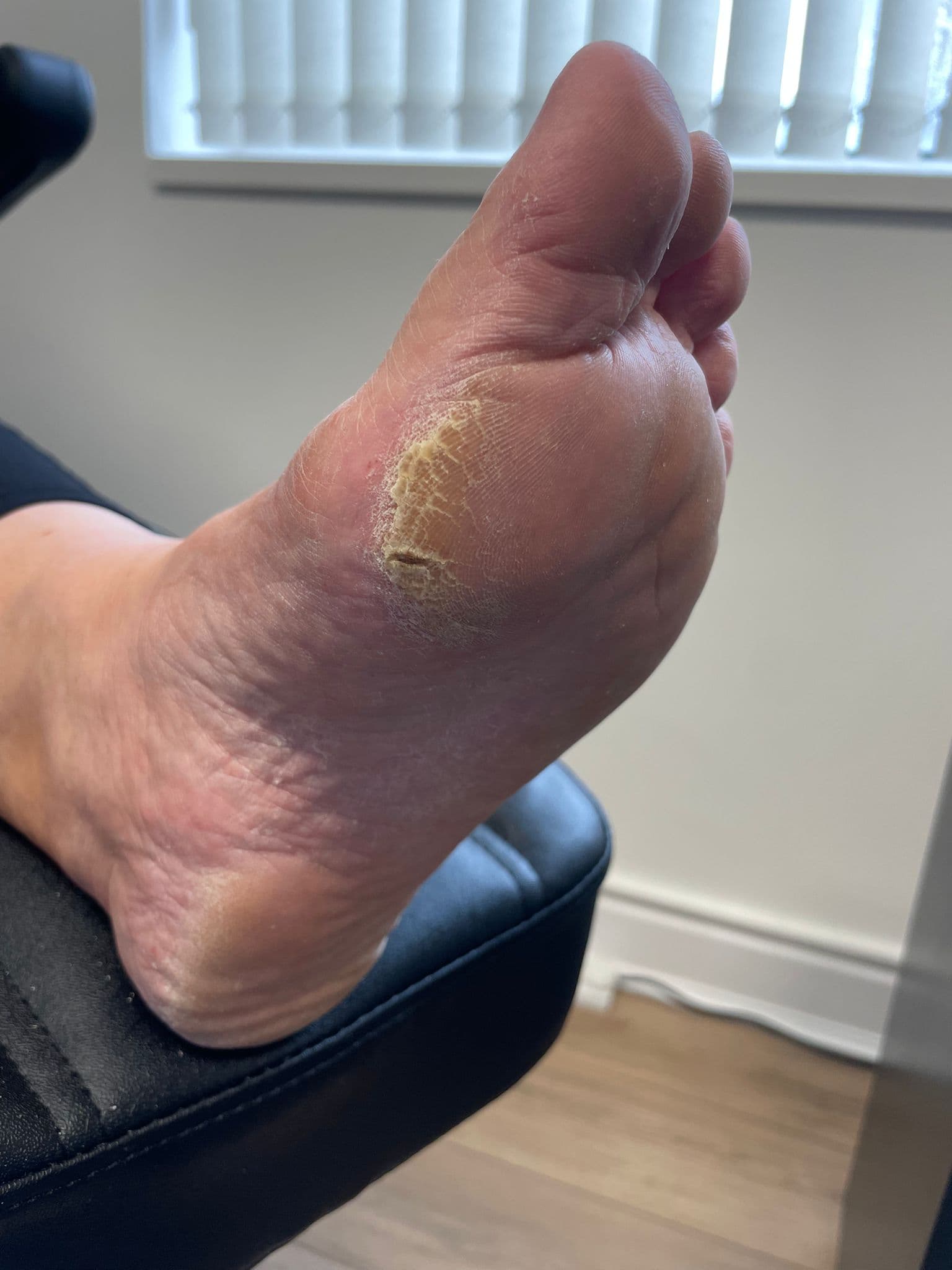Hard Skin (Callus) Treatment before treatment